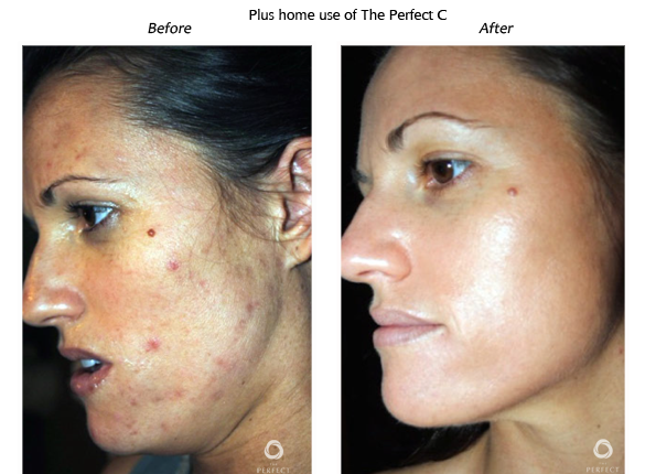 Chemical Peels Treatment